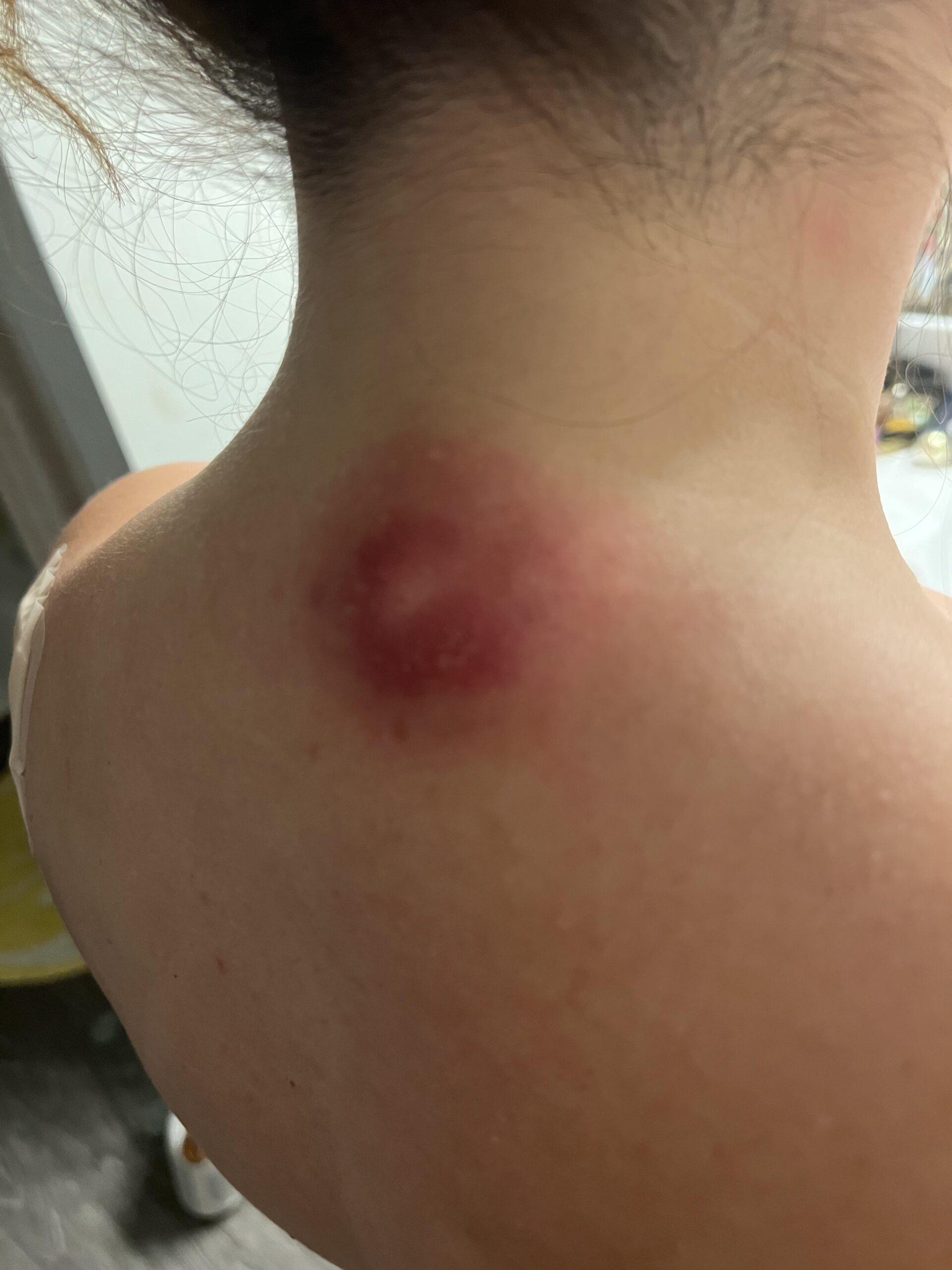 Giant Bump on her Neck?! 😱